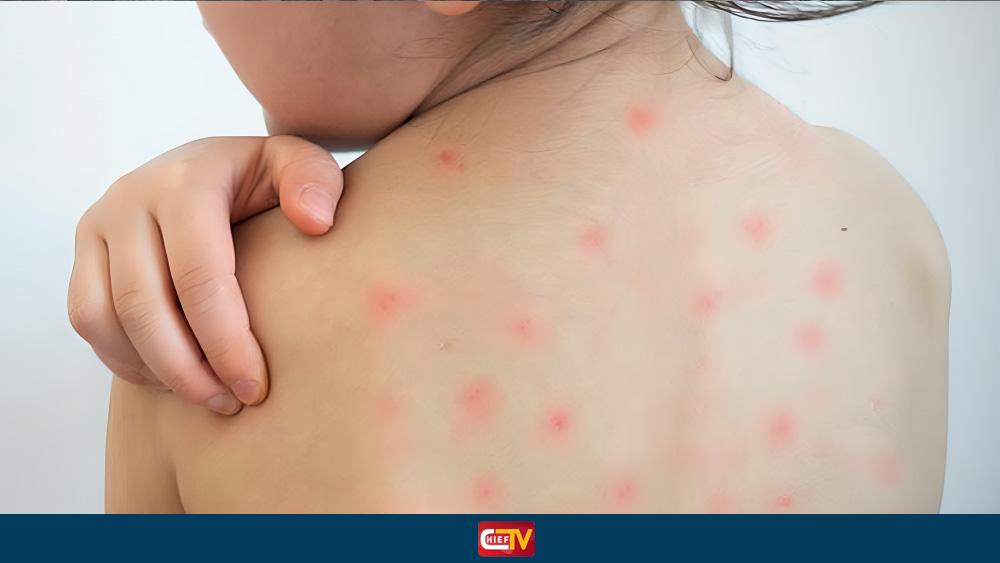 ১৯ দিনে হামের উপসর্গ নিয়ে প্রাণ হারাল ৯৪ শিশু - Chief TV