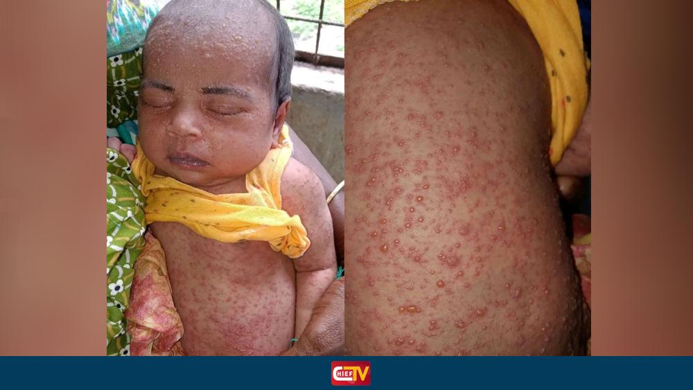 নীলফামারীতে হামের উপসর্গ নিয়ে হাসপাতালে ভর্তি শিশুর মৃত্যু - Chief TV