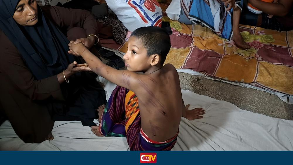 সামান্য কারণে বেত্রাঘাত, মাদরাসায় শিশুর শরীরজুড়ে ক্ষতচিহ্ন - Chief TV